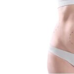 Liposuction surgery