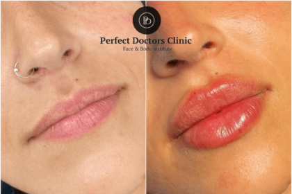 juvederm fillers