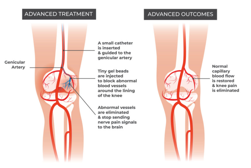 Genicular Artery Embolization