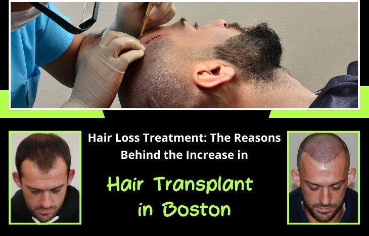 Hair-Loss-Treatment-The-Reasons-Behind-the-Increase-in-Hair-Transplant-in-Boston