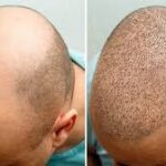 Hair Transplant in Riyadh