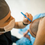 Hair Transplant in Riyadh