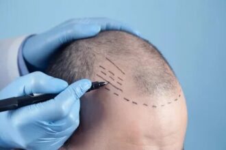 Hair Transplant in Riyadh