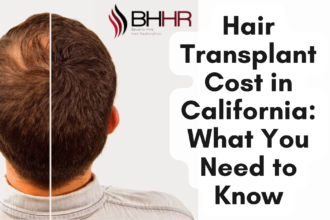 hair transplant los angeles cost