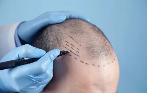 Hair Transplant in Riyadh