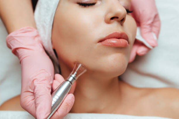 Expert Chemical Peel Treatment & Mole Removal: Achieve Clearer Skin with Advanced Solutions