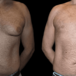 male breast reduction before and after photos