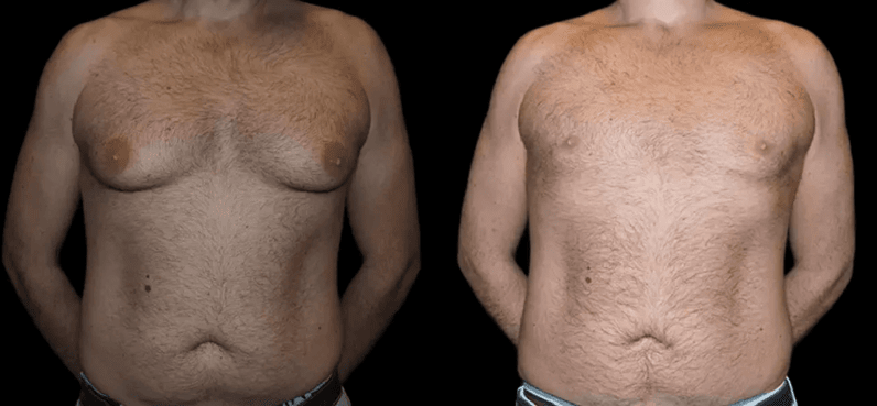 male breast reduction before and after photos