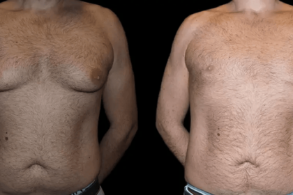 male breast reduction with before and after results