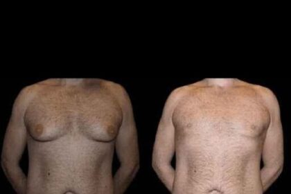 Before and After Male Breast Reduction Results