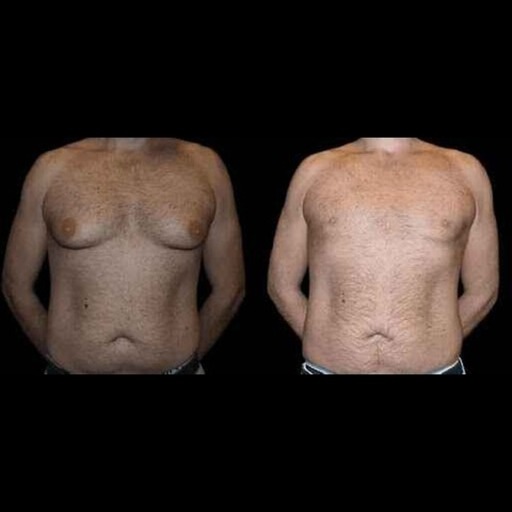 Before and After Male Breast Reduction Results