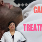 Carbon Peel laser treatment