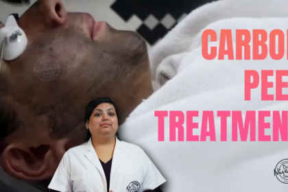 Carbon Peel laser treatment