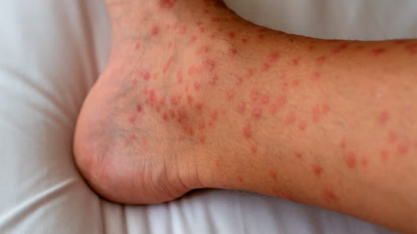 papules eczema