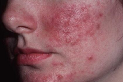 rosacea treatment