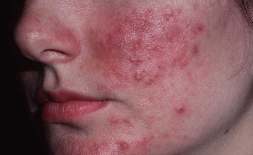 rosacea treatment