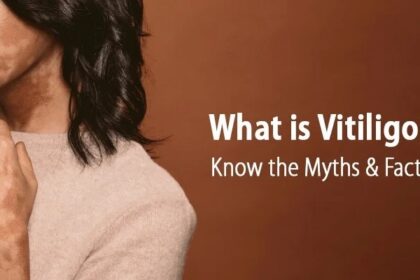 treatment options for vitiligo