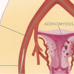 Adenomyosis Treatment in UAE