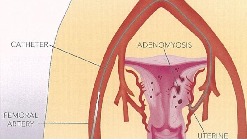 Adenomyosis Treatment in UAE