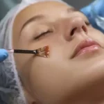 Chemical Peels