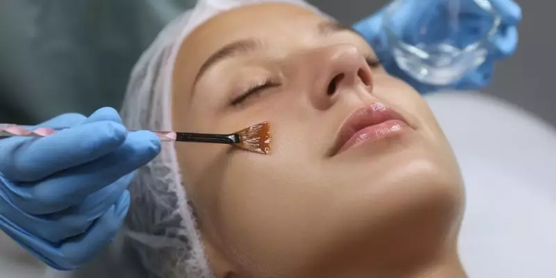 Chemical Peels