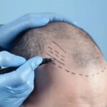 تكلفة زراعة الشعر