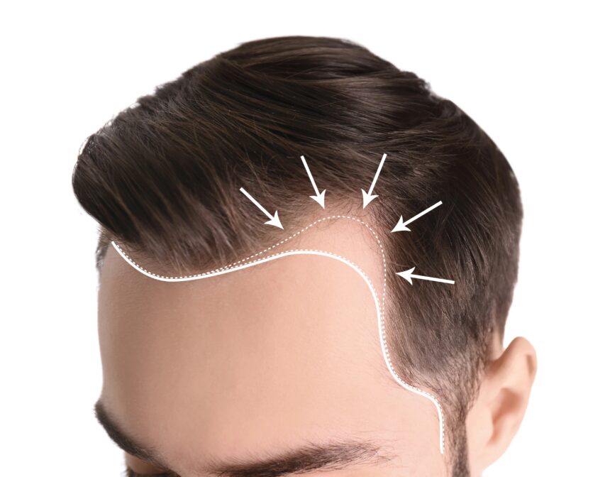 تكلفة زراعة الشعر