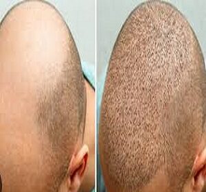 Hair Transplant in Riyadh