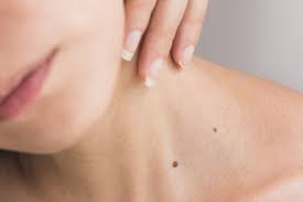 How Long Does Recovery Take After Mole Removal?