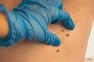 How Much Does Laser Birthmark Removal Cost?