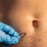 How Much Does Laser Birthmark Removal Cost?