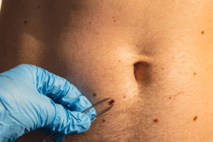 How Much Does Laser Birthmark Removal Cost?