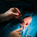 How to Understand Ear Surgery Procedures