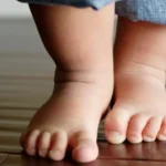 Treating Children’s Flat Feet at Edinburgh Foot Clinics