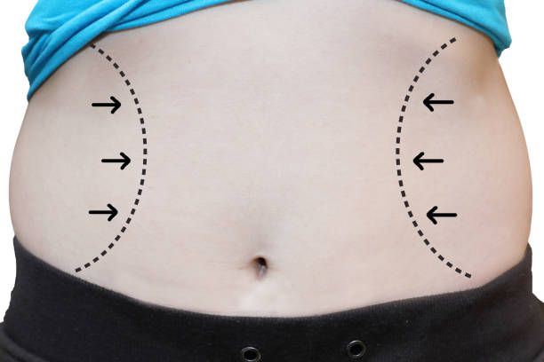 Lipo Abdominoplasty: What Is It and How Does It Work?