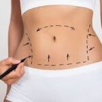 Liposuction Surgery in Dubai