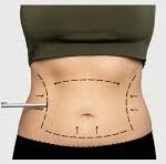 Liposuction Surgery in Dubai