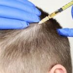 PRP Hair Injection in Dubai