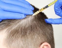 PRP Hair Injection in Dubai