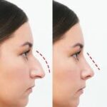 Rhinoplasty in Dubai