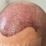 The Complete List of Hair Transplant Cost : Dos and Don'ts