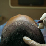 The Complete List of Hair Transplant Cost : Dos and Don'ts