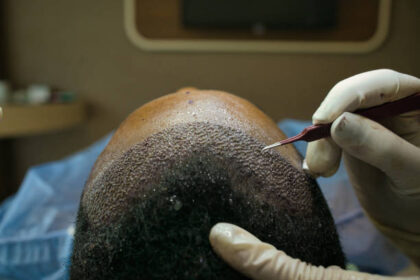 The Complete List of Hair Transplant Cost : Dos and Don'ts