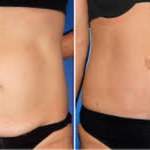 Tummy Tuck