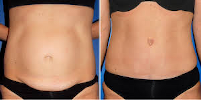 Tummy Tuck