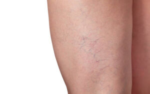 What Are the Best Spider Veins Treatment Options?