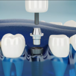 implant supported dentures