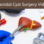 pilonidal cyst surgery video