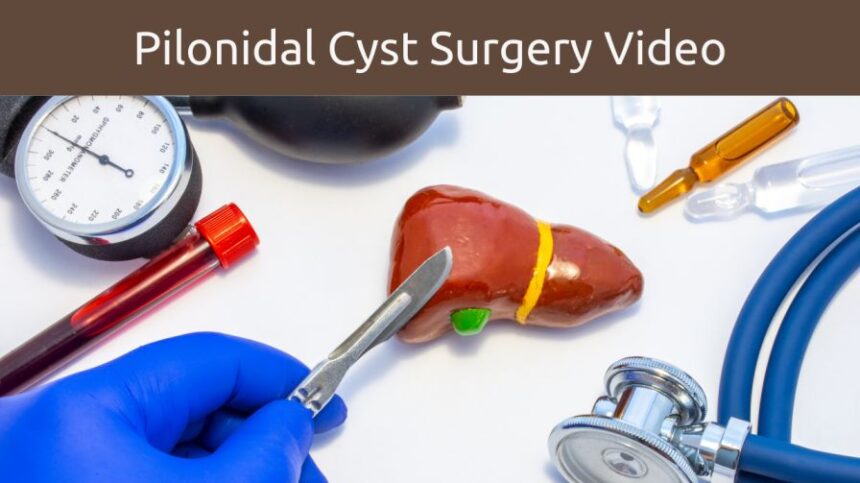 pilonidal cyst surgery video