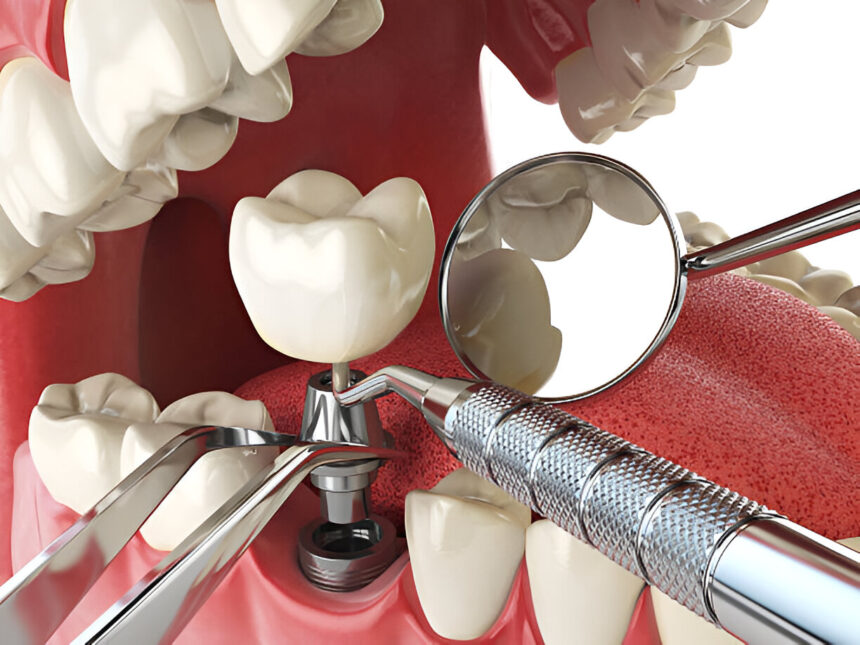 Dental Implants